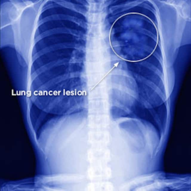 The Township of Teaneck would like to inform all residents about the dangers of smoking and lung cancer during Lung Cancer Awareness Month in November.