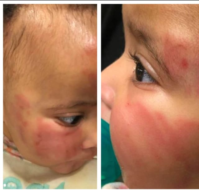 Baby Zuri suffered bruising on her face after a daycare employee fell down the stairs while holding her, her mom Anari Ormond said.