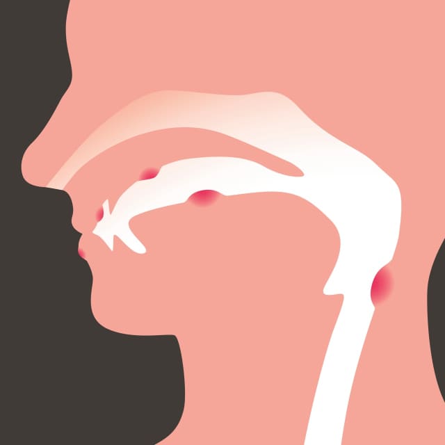 Head and neck cancers are rare but potentially deadly diseases.