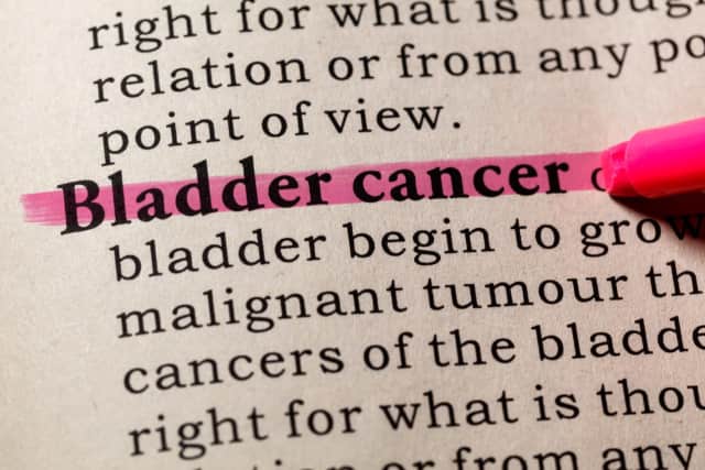 Prevalent, yet rarely mentioned, bladder cancer affects nearly 80,000 adults each year.