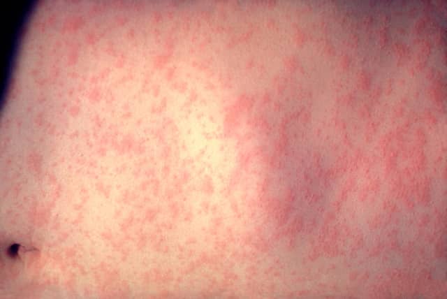 Two isolated cases of measles have been reported in New Jersey.
